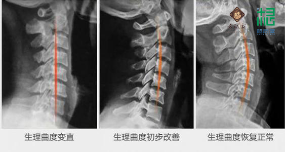 非遗老张家膏贴:颈椎反弓是颈椎病吗?